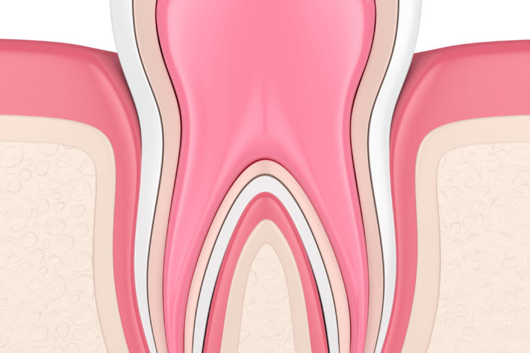 3d render of tooth with root canal treatment procedure