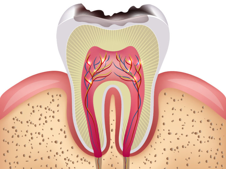 Produits Dentaires Article IrriFlex 