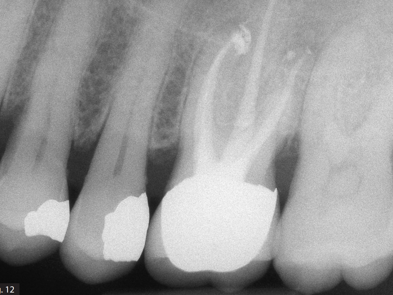 The importance of irrigation in challenging cases with IrriFlex®