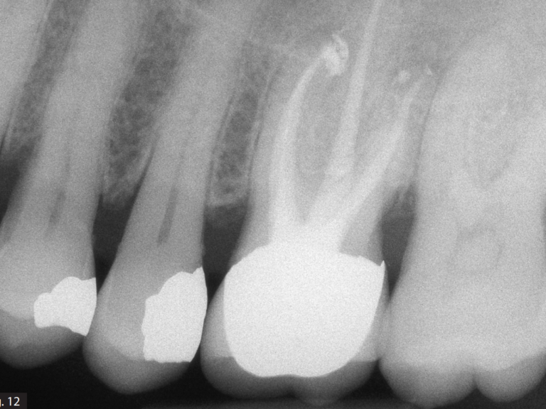 Die Bedeutung der Spülung in schwierigen Fällen mit IrriFlex®