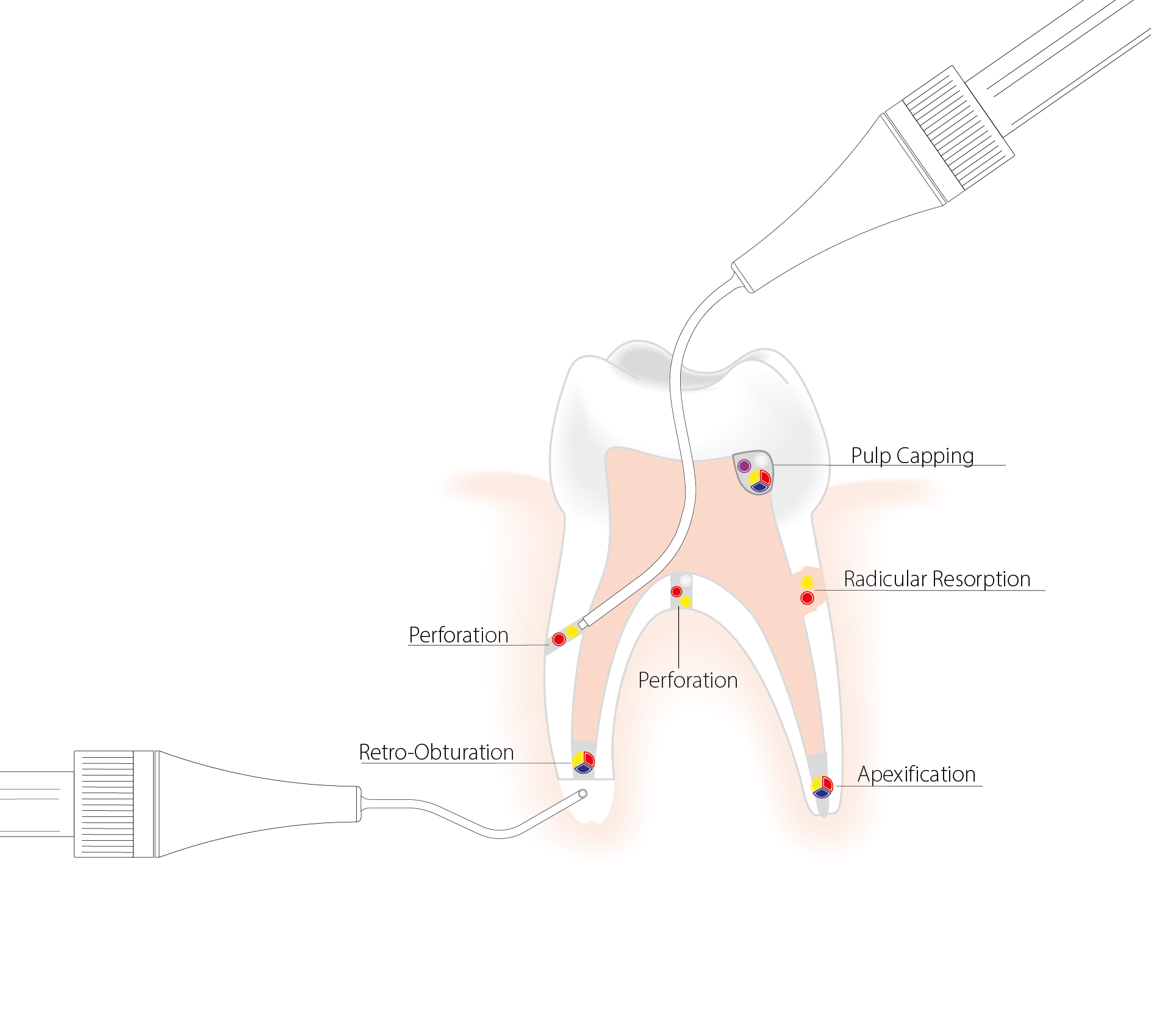 Dent_NiTi+Surgery_needles_FR_210812_v2