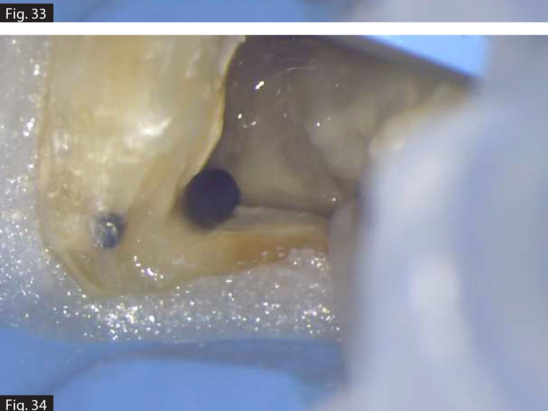 Klinische Aspekte der Endo-Desinfektion von PD Dental Produkte