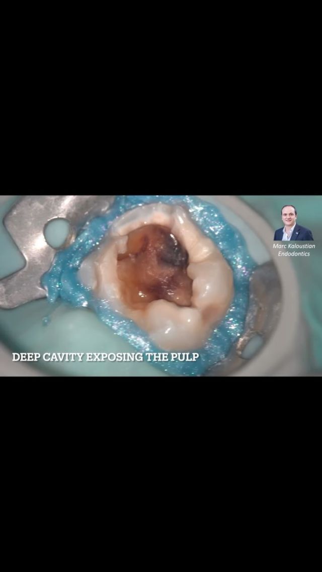 In this clinical video, Dr. Marc Kaloustian performs a pulp capping using bioceramic putty, precisely delivered with the new MAP VPT needles.
He uses the purple MAP VPT needle with an external diameter of 3.4 mm, specifically designed for controlled placement of materials during procedures such as pulp capping.
🆕 MAP VPT is the latest extension of the trusted MAP System, tailored for vital pulp therapies, and includes:
🟣 Purple needle – 3.4 mm external diameter
⚪ White needle – 2.3 mm external diameter
The MAP VPT offers enhanced precision making it ideal for delivering bioceramic materials with confidence.
🔔 Subscribe for more clinical cases and innovative tools in endodontics.
#VitalPulpTherapy #MAPVPT #Endodontics #PulpCapping #MAPSystem #DentalInnovation #MarcKaloustian