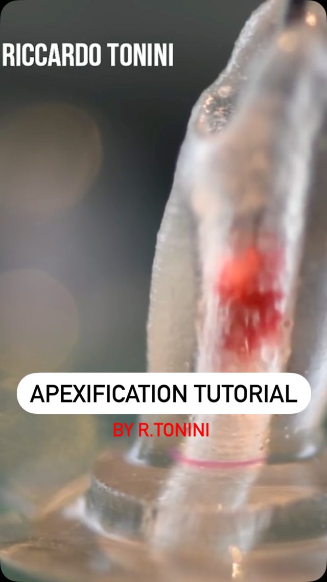 🎥 Apexification tutorial by Dr. Riccardo Tonini!
In this hands-on demo, he walks you through an apexification procedure using our MAP System on a 3D model — showcasing the technique and precision required to place bioceramic material with confidence.
🔍 Perfect for clinicians looking to master bioceramic material placement in endodontic cases.
#Endodontics #Apexification #MAPSystem #DentalTutorial #Biomaterials #swissmade #ProduitsDentaires