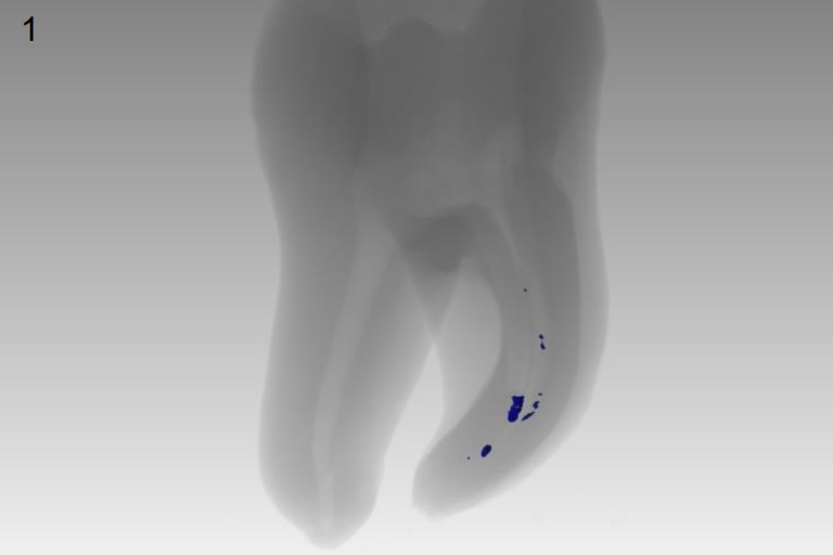 Calcium hydroxide removal in straight and curved root