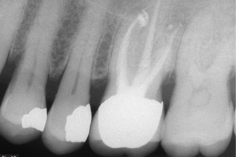The importance of irrigation in challenging cases with IrriFlex®