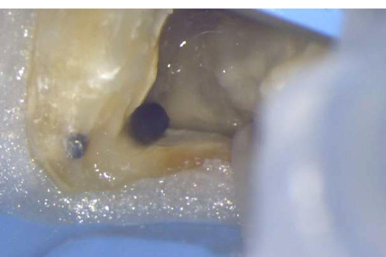 Clinical aspects of endo disinfection with PD Dental products